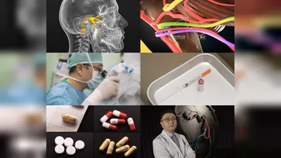 High-frequency radiofrequency treatment for trigeminal neuralgia introduced by Professor Jeong…