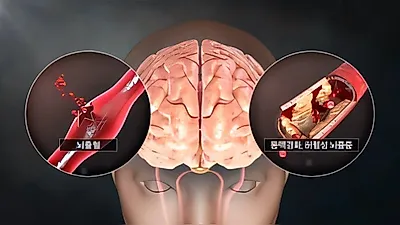 Surge in Stroke Among 20s and 30s; AI Analysis Extends Golden Time up to 24 Hours